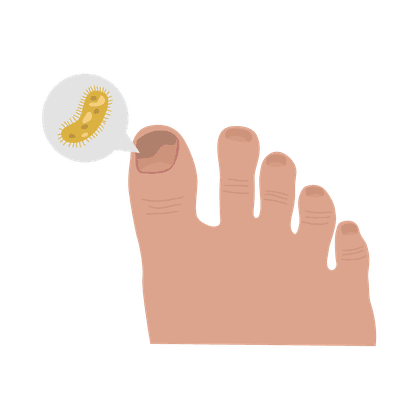 Hongos en las uñas (onicomicosis) y en los pies (pie de atleta)