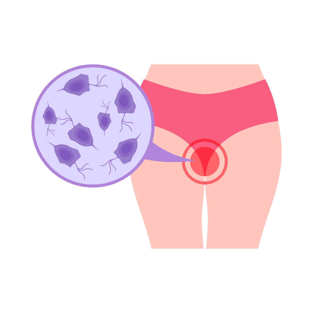 Candidiasi