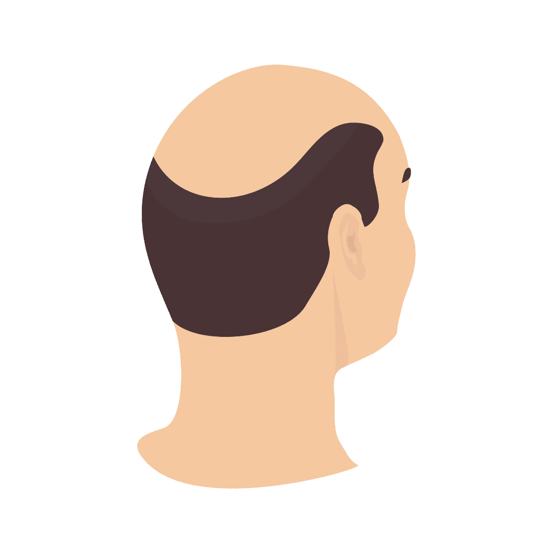 Alopecia (calvicie, caída del cabello)