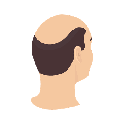 Alopecia (calvizie, perdita di capelli)