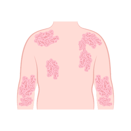 Dermatitis atópica, neurodermatitis