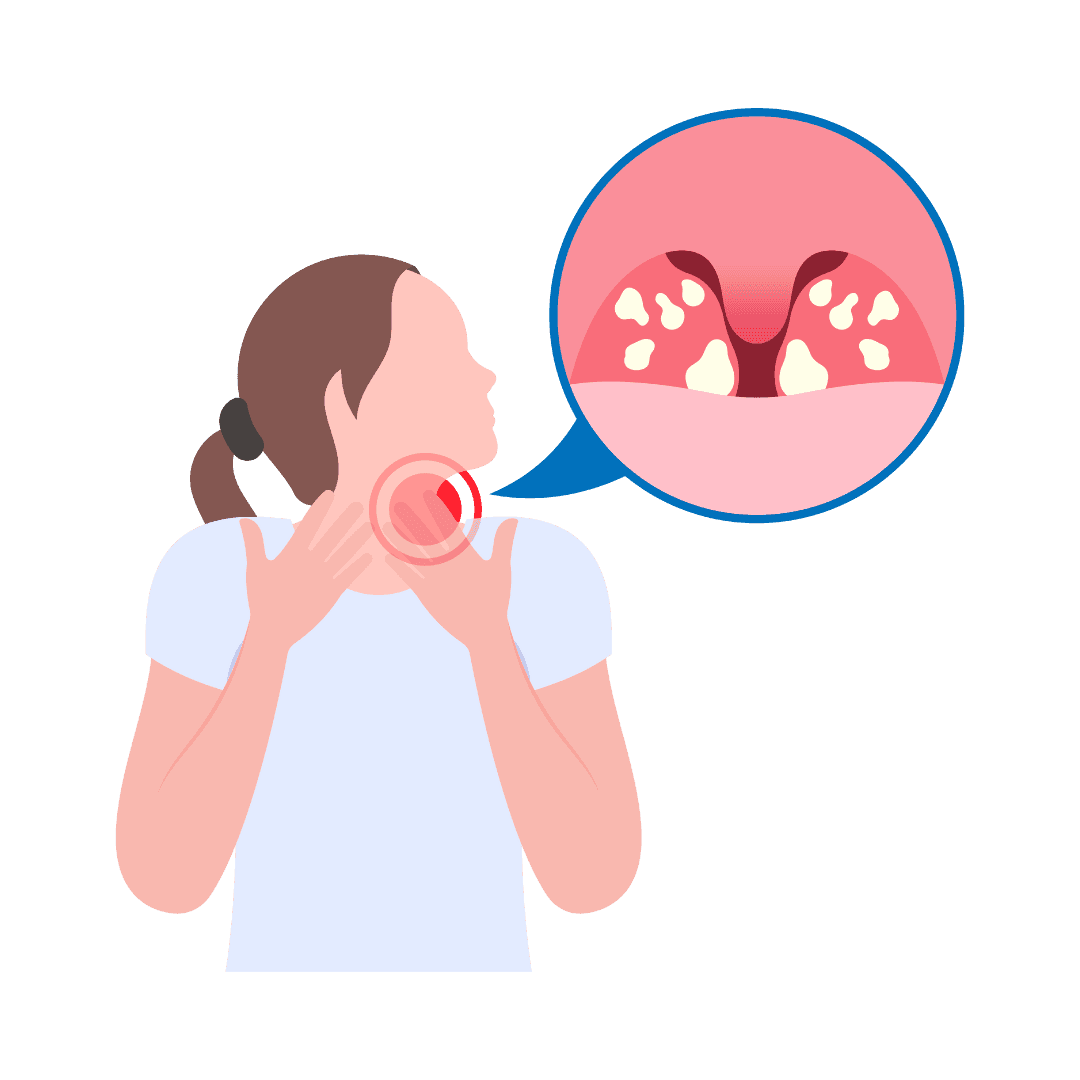 Angina y amigdalitis