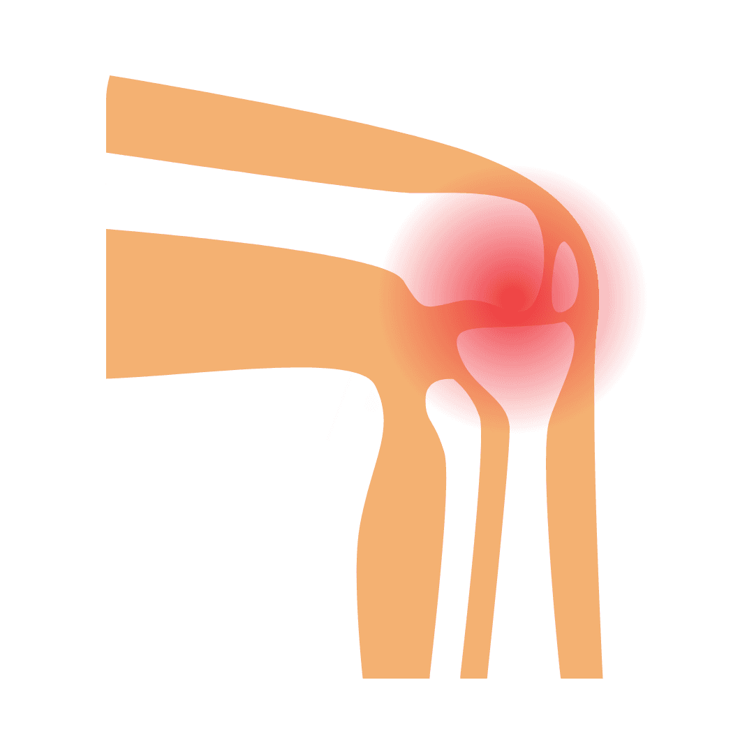 Artritis reumatoide