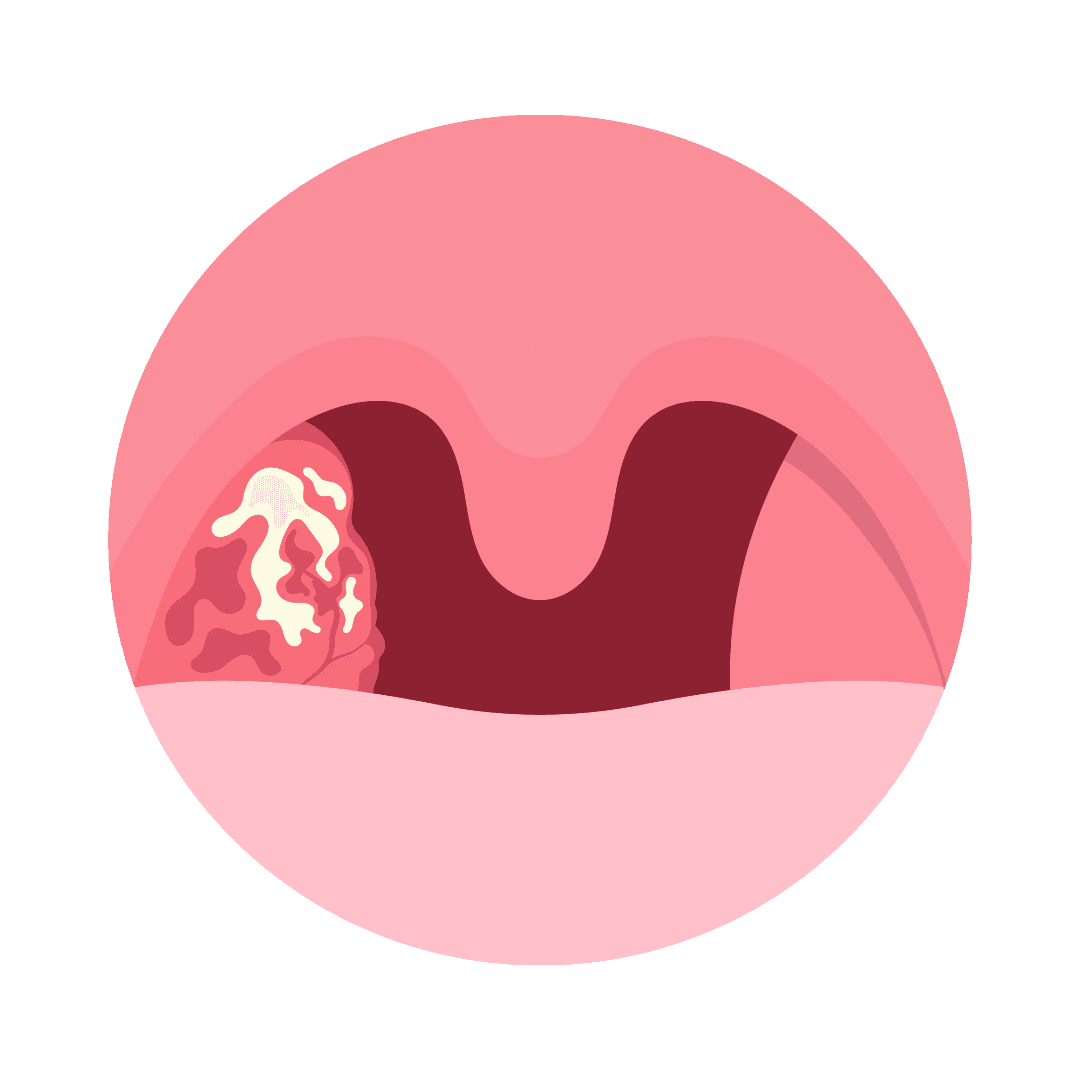 Adenoides en niños