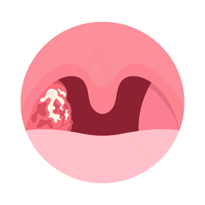 Adenoides en niños