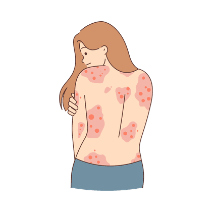 Psoriasi