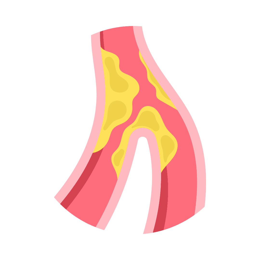 Aterosclerosis