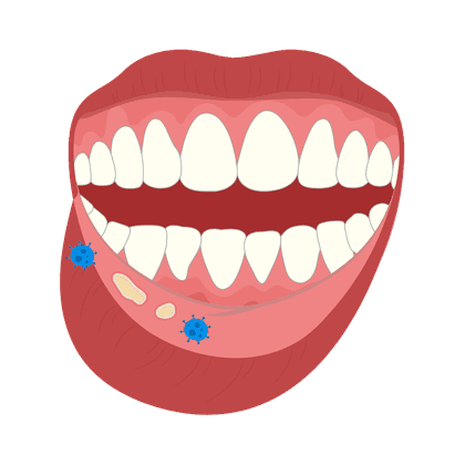 Estomatitis