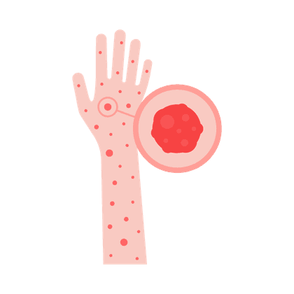Orticaria