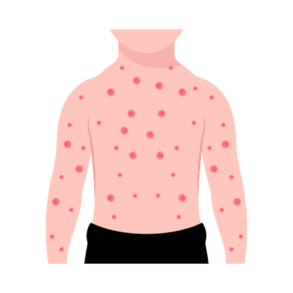 Varicela