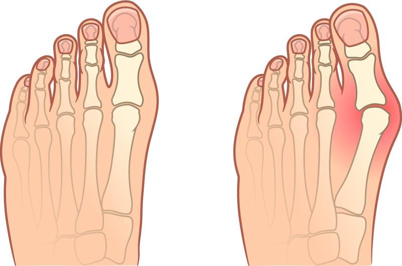 Alluce valgo (bunion)