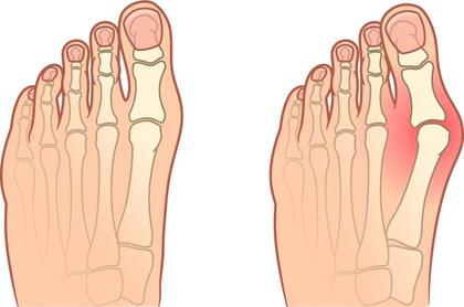 Hallux valgus (juanete)
